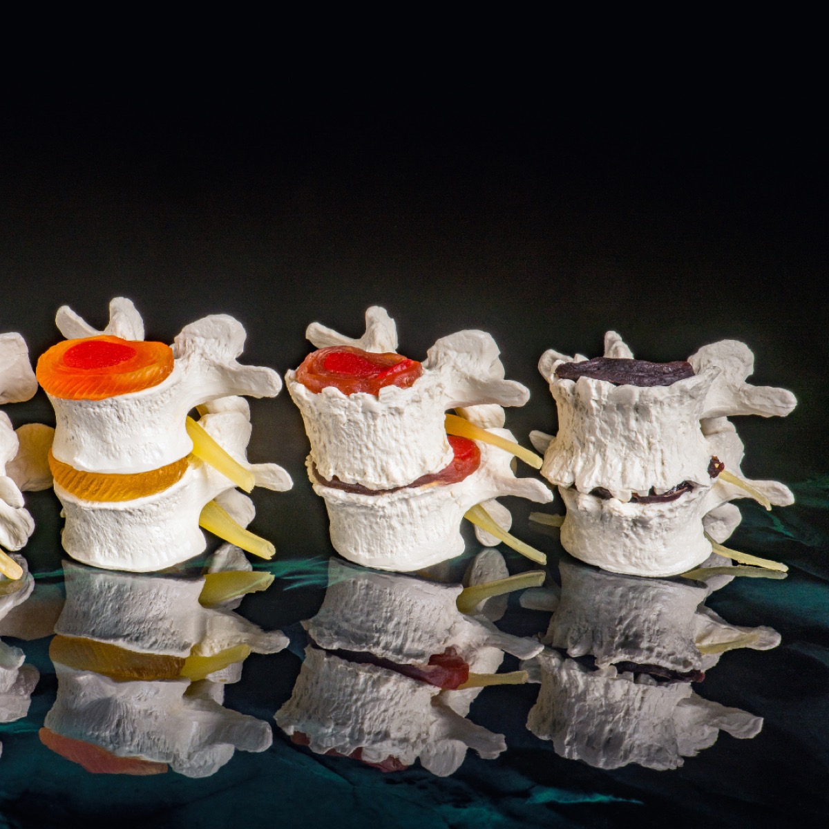 Spine models showing progressive stages of disc degeneration