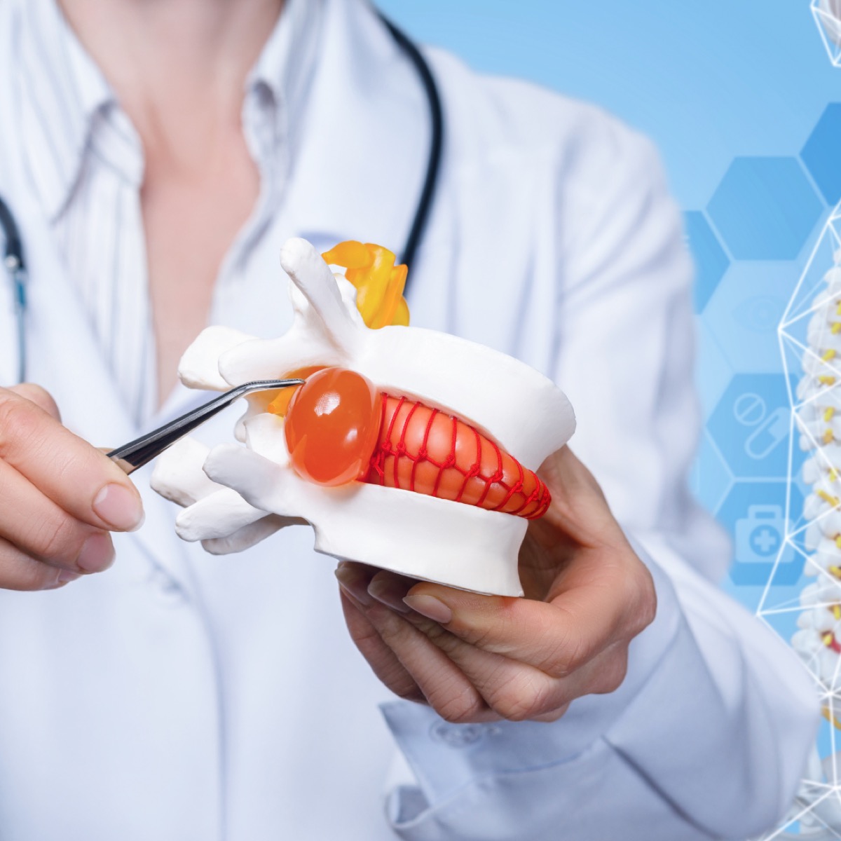 Doctor pointing to a herniated disc on a spine model