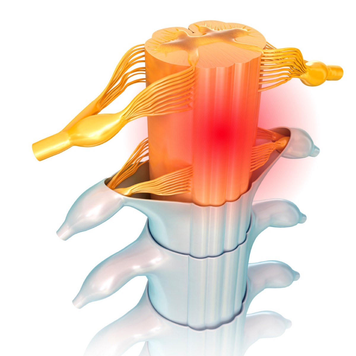 Illustration of spinal nerve compression associated with spinal stenosis