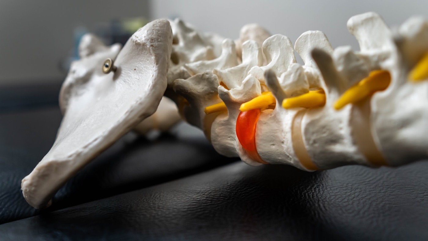 Close-up of a spine model highlighting a herniated disc